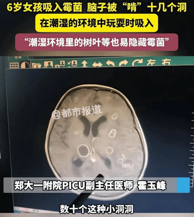 皇冠信用网代理_6岁女童发烧17天皇冠信用网代理，脑子竟被“啃”出十几个洞！“元凶”家中很常见！